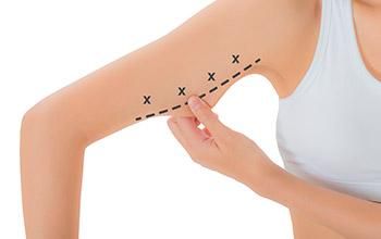 Cirugía estética de brazos