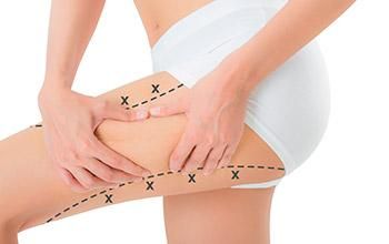 Cirugía estética de piernas (lifting crural)