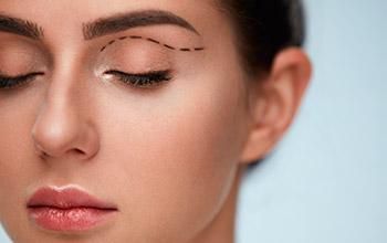 Blefaroplastia superior (cirugía de los párpados superiores)