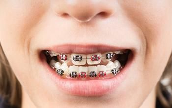 Tratamiento de ortodoncia: Aparatología en ambos maxilares